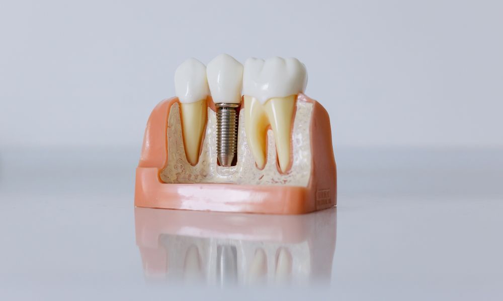 Dental implant model displayed for consultation