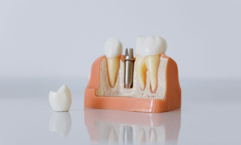 Dental restoration models on a clinic counter